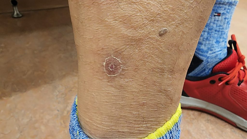 Healed, circular, light colored lesion located on the right lower leg
