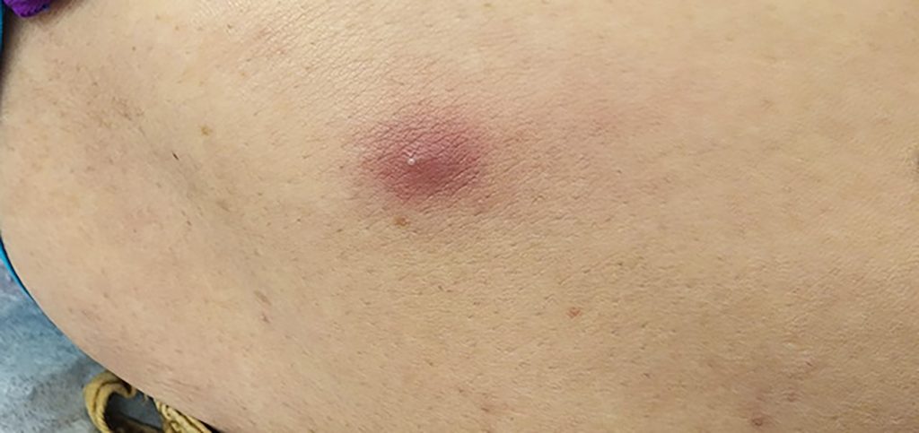 A pustule lesion located on the right thigh.