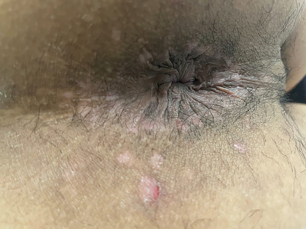Cluster of healed, circular, light colored lesions located around the anus
