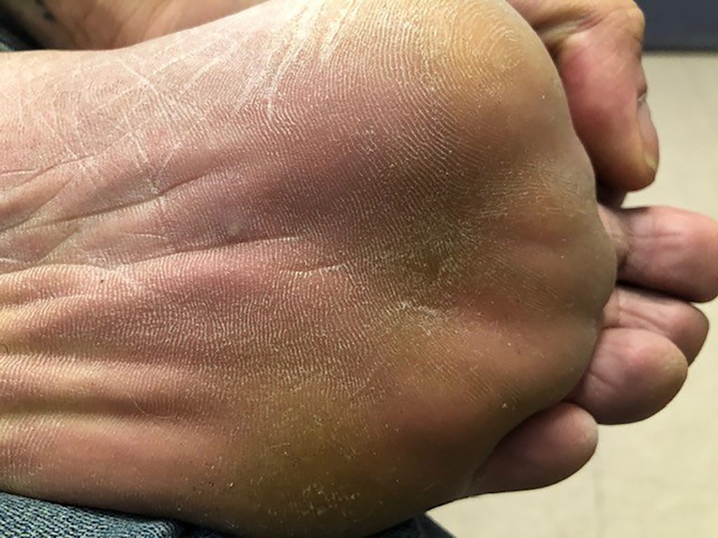 Pustule lesion located on the sole of the foot.