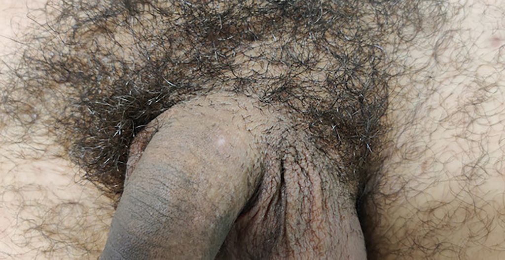Circular, light colored, healed region, on the upper base of the penis.