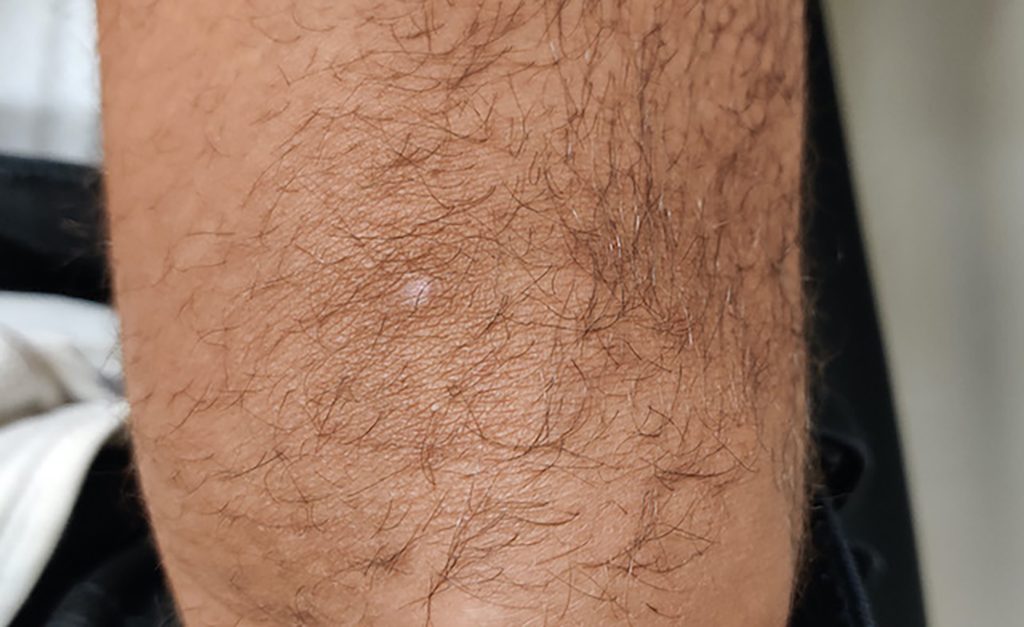 Circular, light colored, healed region, on the knee.