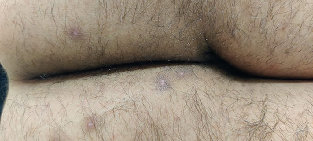 Cluster of healed, circular, light colored lesions with a border of darker skin around them located around the anus