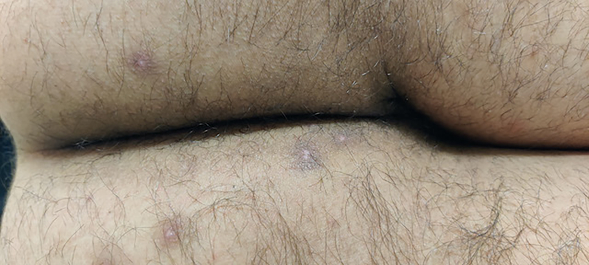 Primary perianal healed lesions