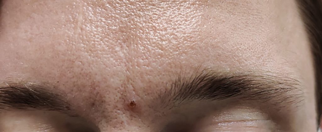 Circular, scabbed lesion with flaking skin around its perimeter, located on the forehead.