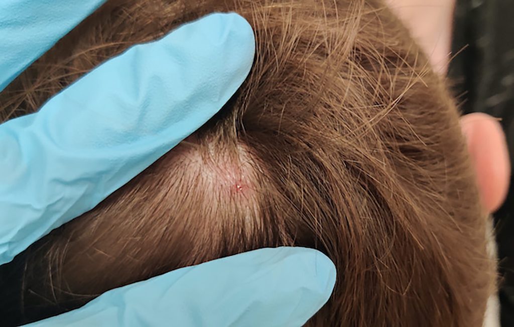 Circular, ulcer located on the scalp.