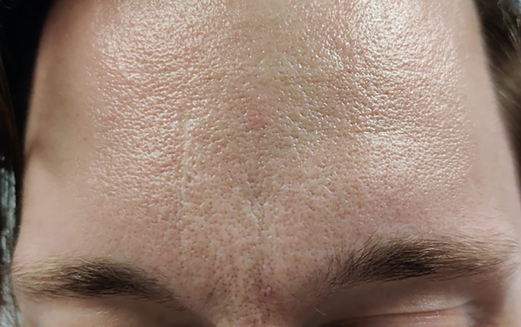 Light colored, healed region on the forehead.