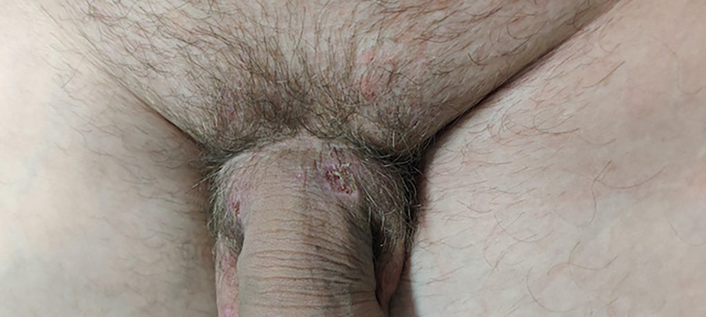 Circular, ulcer located on the upper base of the penis.