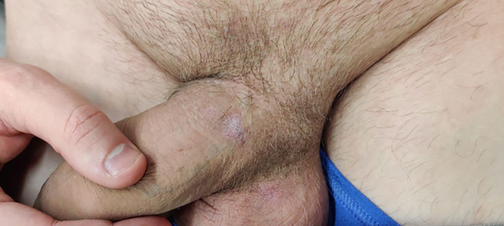 Cluster of healed, circular, light colored lesions, located on the upper base of the penis.