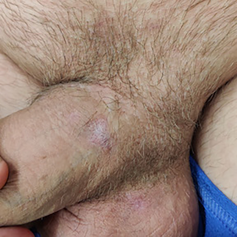 Cluster of healed, circular, light colored lesions, located on the upper base of the penis.