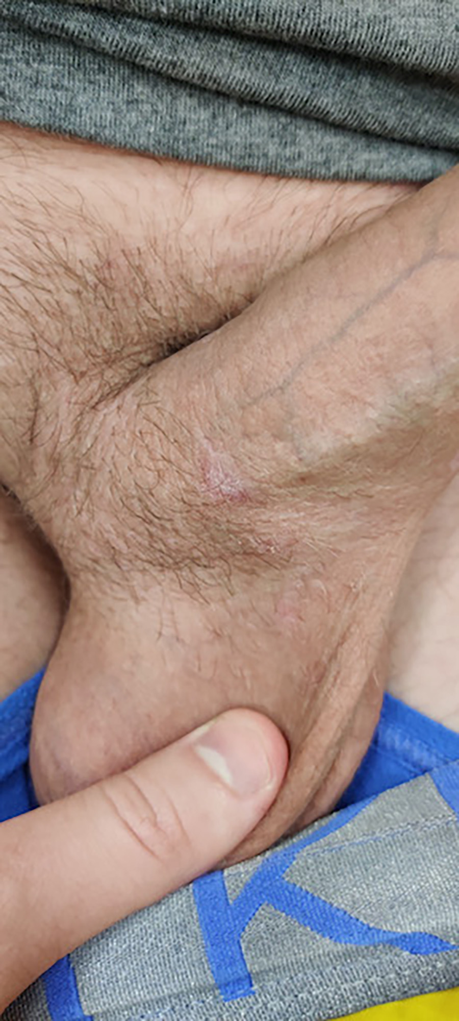 Healed secondary penile lesion right side