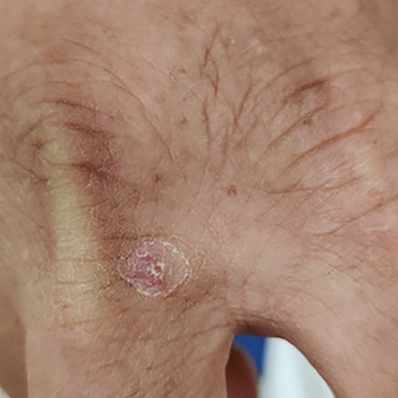 Circular scabbed lesion that is dry with flaking skin on the ends. Located on the hand.