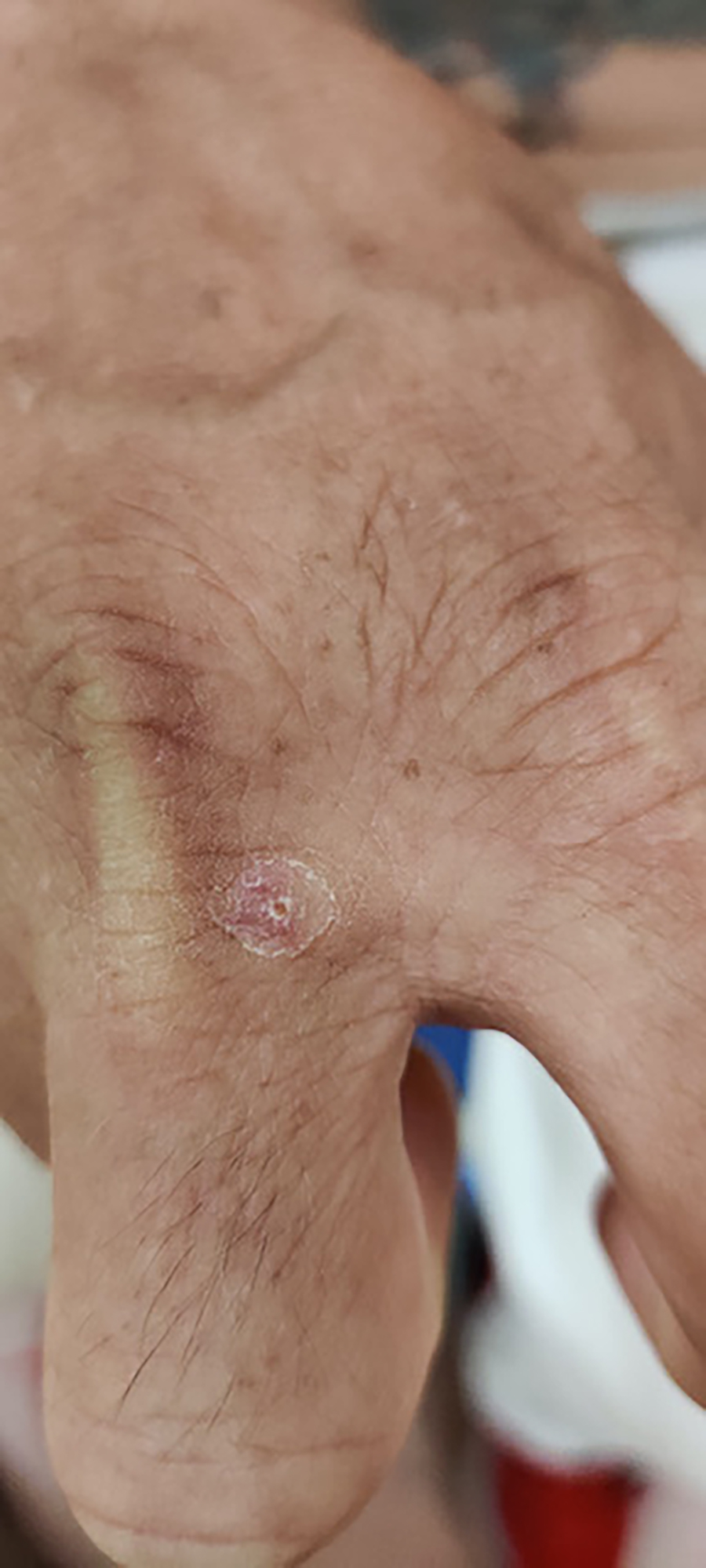 Secondary healed lesion IP right