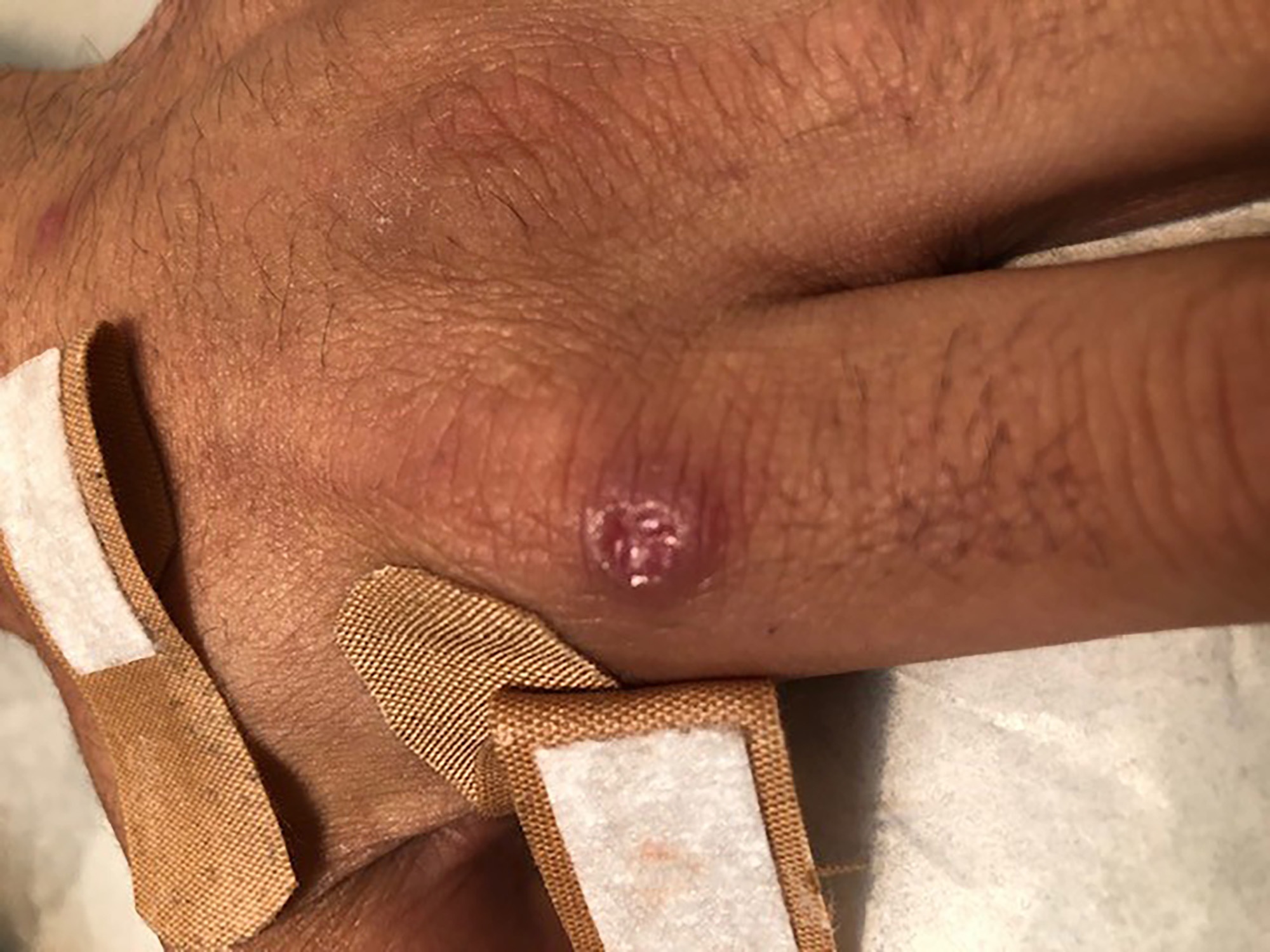 Secondary ulcer on the left hand