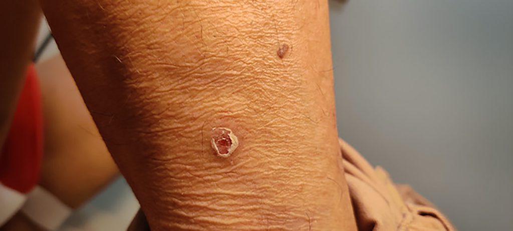 Circular, scabbed lesion with flaking skin around its perimeter. Located on the knee.