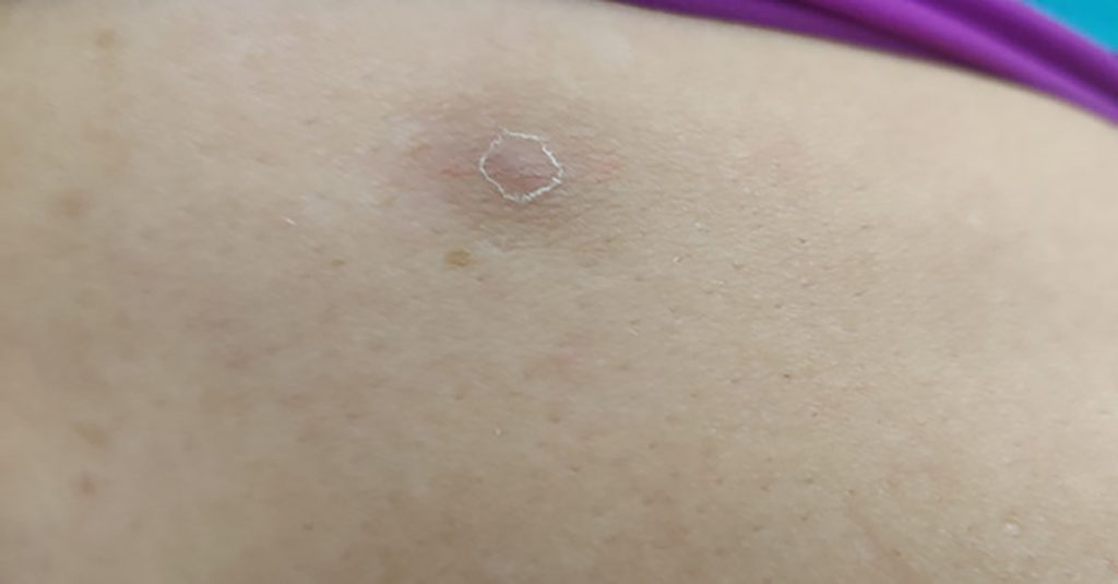 Circular, light colored, healed region, on the right thigh.