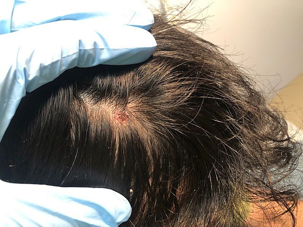 Scabbed lesion located on the scalp.