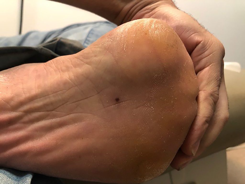 Circular, scabbed lesion with a border of darker skin around, located on the sole of the foot.
